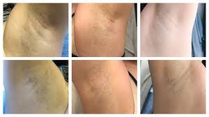 Shaving, as you already know is not effective for permanent. Underarm Laser Hair Removal Your Questions Answered