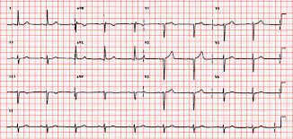 10 the gold standard is the biopsy of the myocardium, in general done in the setting of angiography. Blocco Atrioventricolare Di I Grado Wikipedia