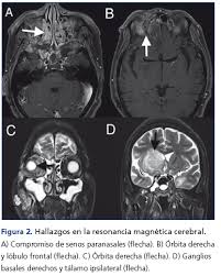 Tratamiento diuretico de la insuficiencia cardiaca // rev. Tratamiento Exitoso De Mucormicosis Rino Orbito Cerebral En Un Paciente Trasplantado Renal