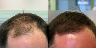 As hair is regarded as an asset that enhances oneís physical appearance, balding or thinning hair is a problem that. Top Hair Loss Treatments For Men In Singapore For Balding And Thinning Hair