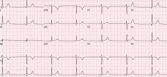 Interpretasi pemeriksaan elektrokardiografi (ekg) merupakan salah satu kompetensi yang harus dikuasai seorang dokter berdasar standar kompetensi dokter indonesia (skdi) 2012. Gambaran Ekg Aritmia Alomedika