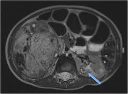 Image result for Nephroblastoma