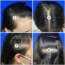 It's caused by a breakdown in the normal communication between nerves and muscles. Hair Loss List Of Frontiers Open Access Articles