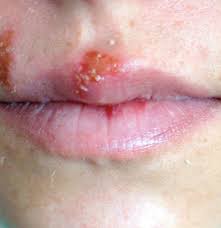 Both viral infections consist of lesions that come and go depending on the stress level of the person and their health status. Herpes Skin Rash Symptoms Identification And Treatment