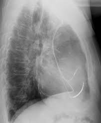Maybe you would like to learn more about one of these? Kardiologie Herzschrittmacher Defibrillatoren Kardiale Resynchronisations Therapie