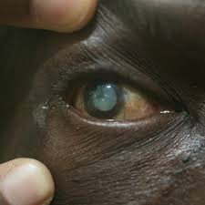 To determine whether you have a cataract, your doctor will review your medical history and symptoms, and perform an eye examination. Tests To Diagnose A Cataract
