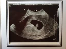 It checks your baby's growth and development, as well as establishing a more precise due date. 7 Week Scan