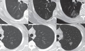 The 9 factors that impact small cell cancer of the pancreas learning about medical care for cancer of the pancreas can help you take an active painful inflammation of the pancreas. Slow Growing Lung Cancer As An Emerging Entity From Screening To Clinical Management European Respiratory Society