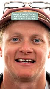 Chapas De Porcelana De Corey Antes Y Después De La Nueva Transformació...