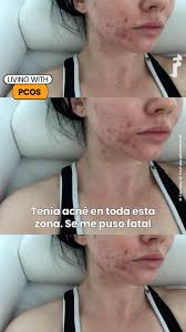 El Síndrome del Ovario Poliquístico