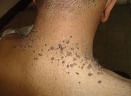 Las verrugas en el cuello (acrocordones) no son causadas por vph. 3 Razones Por Las Que Salen Verrugas En El Cuello