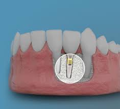 Dental implants can help replace missing teeth. Dental Implant Cost Santa Fe Nm Taos Nm Los Alamos Nm Oral Surgery And Dental Implant Center Of Santa Fe