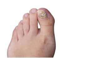 And it may lead to other serious infections that spread beyond your feet if you have a suppressed immune system due to medication, diabetes or other conditions. How To Properly Treat A Toenail Infection Advanced Tissue