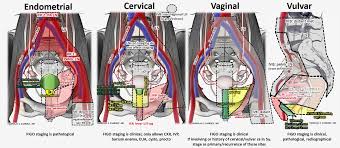 Tumor involves 1 or both ovaries with pelvic extension (below the pelvic brim) or primary peritoneal cancer. Nicholas Zaorsky Md Ms On Twitter Cervical Cancer Staging Mnemonic Iiib Can T Pee Hydronephrosis Nrgonc Acog Timshowalter1 Sushilberiwal Gyncsm Obgyn Cervicalcancer Womenshealth Https T Co S4s2to4zal