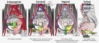 At cancer treatment centers of america® (ctca), we use the results from diagnostic tests to develop a treatment plan tailored to the patient, based on the stage of the disease. Nicholas Zaorsky Md Ms On Twitter Cervical Cancer Staging Mnemonic Iiib Can T Pee Hydronephrosis Nrgonc Acog Timshowalter1 Sushilberiwal Gyncsm Obgyn Cervicalcancer Womenshealth Https T Co S4s2to4zal