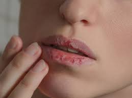 Brennende Lippen Diese Tipps Helfen Wirklich