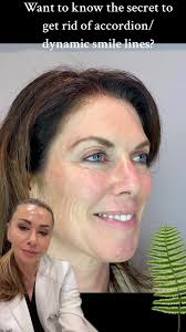 Transform Your Smile Lines with the Fern Technique