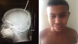 13-year-old Maryland boy survives freak accident with 6-inch screw lodged  in his skull