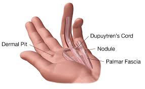 We did not find results for: Enfermedad De Dupuytren Cirugia De Columna En Matamoros