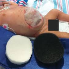 In the automotive industry they are used for making gaskets, spark plug boots, hoses and other components that must operate over a. Pdf Serial Reduction Of An Extremely Large Gastroschisis Using Vacuum Assisted Closure