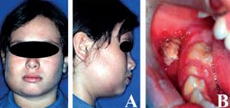 Eat foods rich in antioxidants such ad spinach, carrots, green leafy vegetables, beat roots, raspberries, etc. Scielo Brasil Diagnosis And Management Of Eosinophilic Granuloma Of The Jaw A Case Report Diagnosis And Management Of Eosinophilic Granuloma Of The Jaw A Case Report