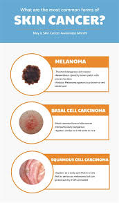 Because of this, the lesions are often called precancer. What Are The Signs Symptoms Of Skin Cancer Molescope Skin Cancer Signs Symptoms Studies Indicate That Nearly 10 000 People Are Diagnosed As With Most Cancers Early Detection Is Important