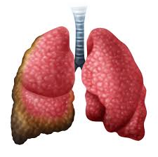 When cancerous tumors form on connective tissues, it is a sarcoma. Ramucirumab Added To Gemcitabine Extends Survival In Previously Treated Malignant Pleural Mesothelioma