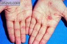 Check spelling or type a new query. Laer Hvordan Du Kan Forhindre Syfilis En Sykdom Som Er Mer Vanlig Enn Du Kanskje Tror Vitenskap 2021