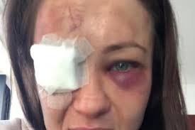Feb 24, 2020 · karolina kowalkiewicz podczas swojej ostatniej walki w ufc doznała poważniej kontuzji oka. Karolina Kowalkiewicz Po Walce Strasza Ze Moze Stracic Wzrok