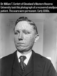 Image result for Smallpox