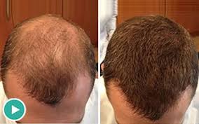 Caboki Hair Loss Breakthrough