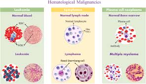 Image result for Hematologic Cancer
