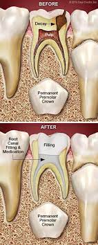 A Pulpectomy Is Root Canal Therapy On A Primary Or Baby Tooth While Many People Believe That Because It Will F Dental Decay Dental Treatment Dental Help