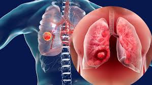 Are You At Risk of Lung Cancer If Your Family Has Suffered The Disease? | TheHealthSite.com