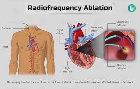 Radiofrequency ablation: Procedure, Purpose, Results, Cost, Price, Indications, Recovery
