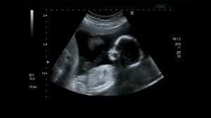The pregnancy network is the only place in guilford county to provide free ultrasounds. Ultrasound Stock Video Footage Royalty Free Ultrasound Videos Pond5