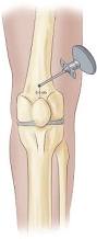 Image result for Intraosseous Access