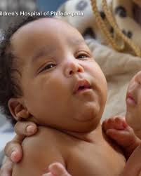 Twin brothers born conjoined celebrate 1st birthday after separation  surgery