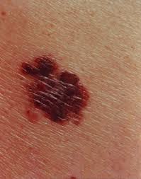 Skin cancer is by far the most common type of cancer. Melanoma Medlineplus Genetics