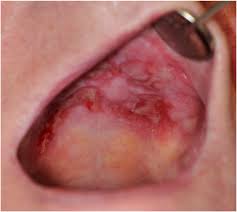Image result for lichen planus on tongue)