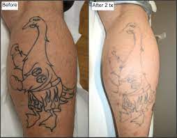 In addition to being skilled in the use of. Tattoo Removal By Jayvo Scott Millefiori