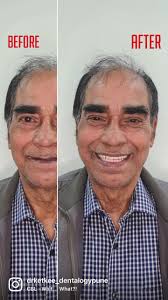 FIXED TEETH ARE “ALWAYS” AN OPTION TO DENTURES 🙂 , Yes! You read it right!  , After months of planning and multiple procedures, we were able to give  fixed teeth to an EX-ARMY DOCTOR! , Grateful he ...