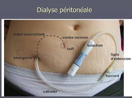 Epingle Sur Dialyse