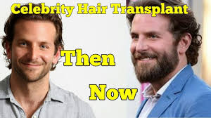 Even with all their money and influence, celebrities are not immune to hair loss and baldness. 20 Celebrity Hair Transplants Before And After Youtube