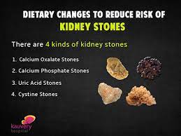 Dietary Changes To Reduce Risk Of Kidney Stones