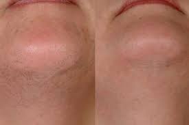 Maybe you would like to learn more about one of these? Laser Hair Removal Near Me Laser Hair Removal Before And After
