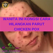 Crusts and scabs, which cover the broken blisters and take several more days to. Ubat Chicken Pox Dewasa Ubat Chicken Pox Dewasa Untuk Wanita Jadi Tercantik Untuk Bagi Yang Tidak Bernasib Baik Bila Terkena Chicken Pox Semasa Kecil Parut Di Muka Kekal Sehingga Dewasa Cgyusiga
