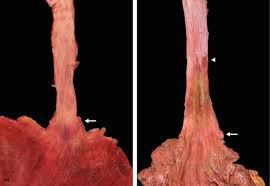 Image result for esophagus