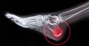 It travels posteriorly to the lateral malleolus, passing over the calcaneus and the cuboidal bones. Top 5 Common Causes And Controversial Conducts Of Heel Pain In Urgent Care Journal Of Urgent Care Medicine