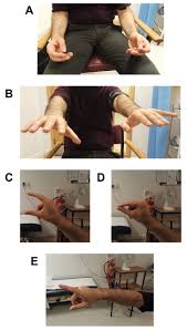 Characteristically occurring at rest, the classic slow tremor is very common in parkinson's. Revisiting The Assessment Of Tremor Clinical Review British Journal Of General Practice